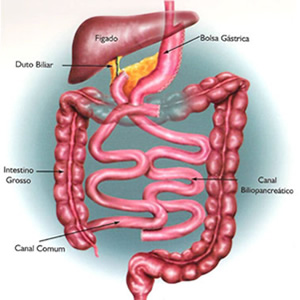 Desvio bilio pancreático (Scopinaro)