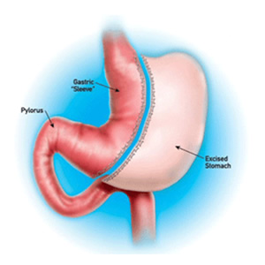 Gastrectomia vertical (Sleev)
