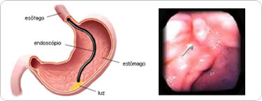 Gastrite e Úlcera Péptica